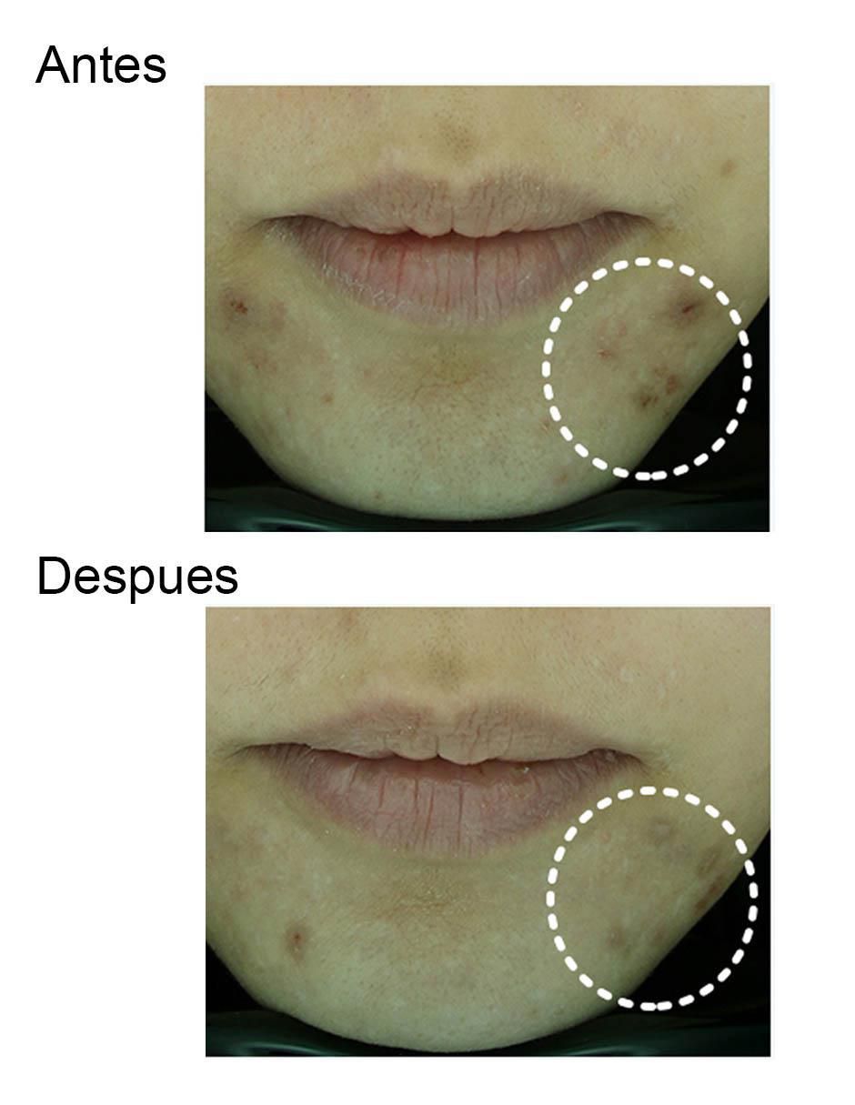 Crema facial recomendada para acné día y noche Tony Moly Acné Y Poros para piel seca y sensible