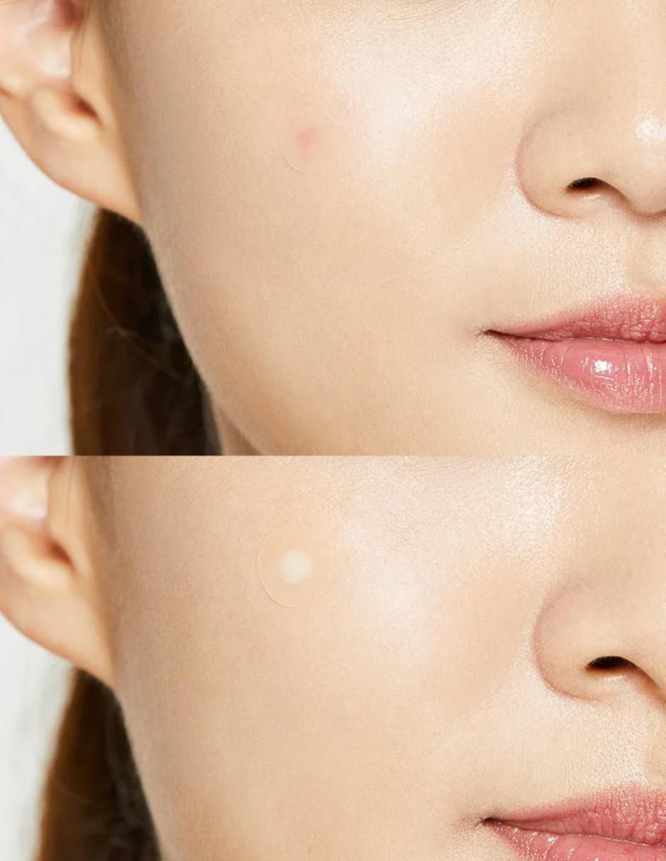 Parches para acné pimple master