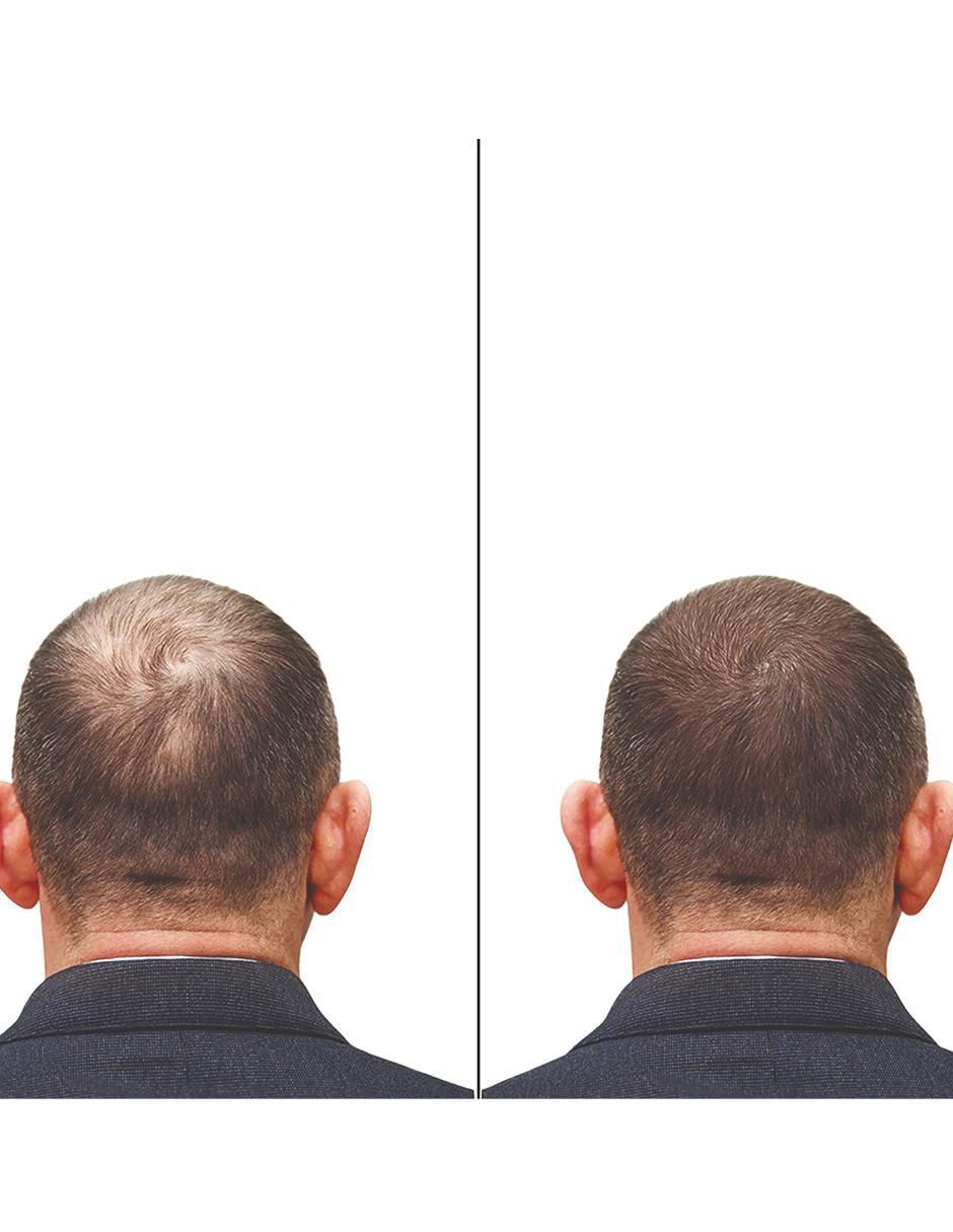 Tratamiento para cuero cabelludo Dutasterida 0.5Mg 100 Tabletas Marca crecimiento Tratamiento para cuero cabelludo Dutasterida 0.5Mg 100 Tabletas Marca crecimiento