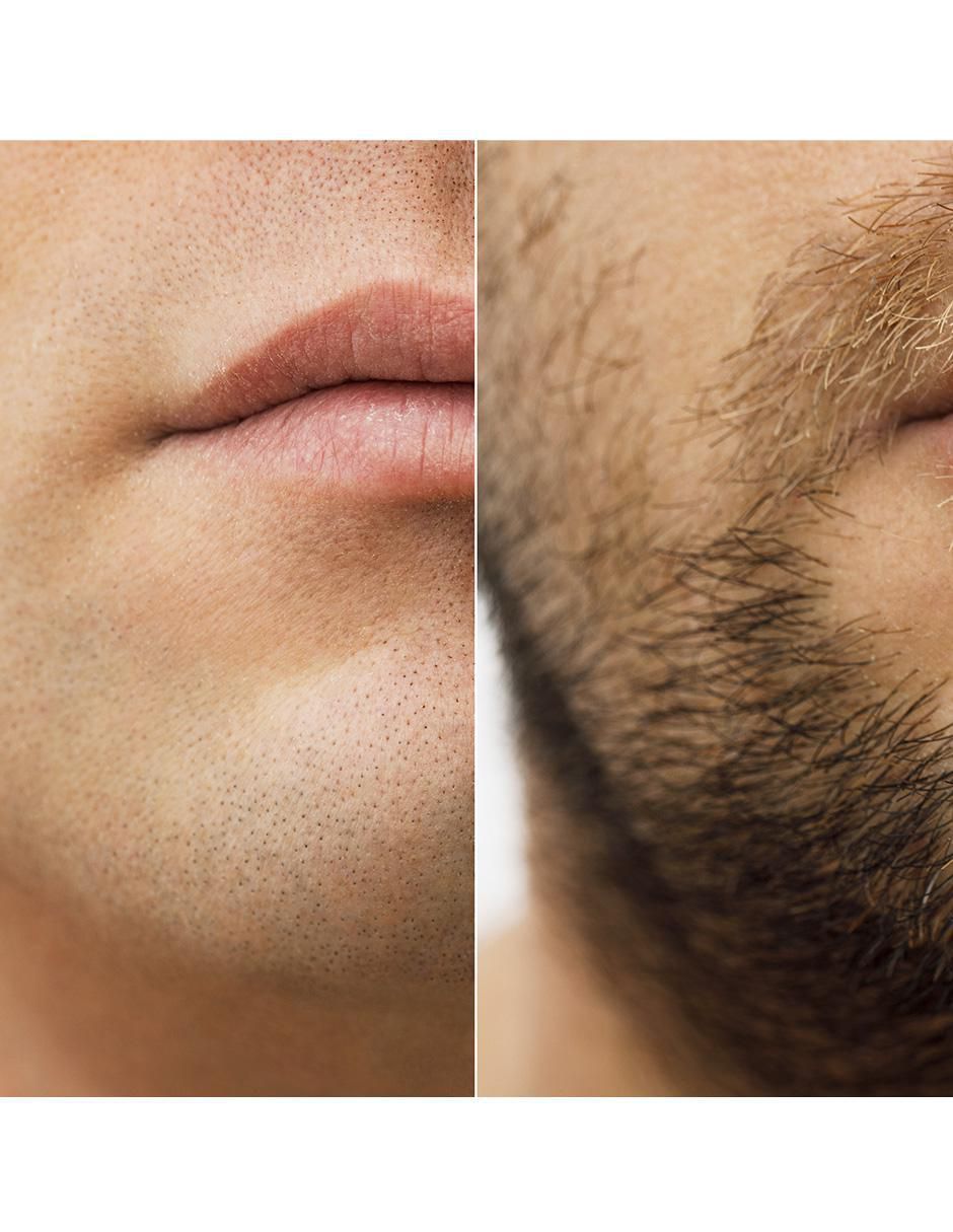 Tratamiento para barba y cabello Minoxidil 5Mg + Aminexil crecimiento 3
